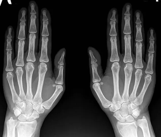 arthrite de l'articulation du poignet aux rayons X avant d'utiliser Hondroine