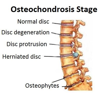 Étapes de l'ostéochondrose