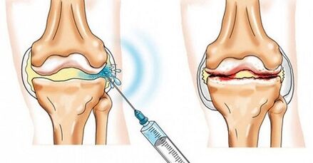 Comment traiter l'arthrose de l'articulation du genou