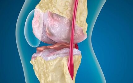 Les raisons du développement de l'arthrose de l'articulation du genou